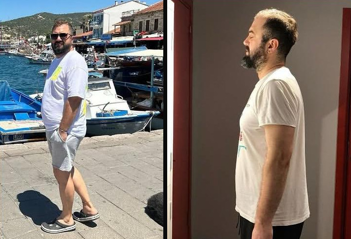 Erkek danışan öncesi ve sonrası